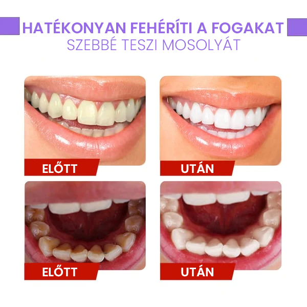 Fogszínkorrektor és zománcápoló szérum