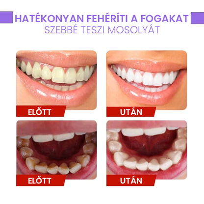 Fogszínkorrektor és zománcápoló szérum